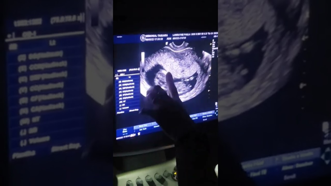 1°MORFOLÓGICA 12 SEMANAS E 2 DIAS