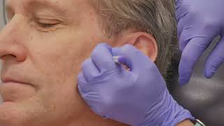 Derm Mohs Procedure FINAL