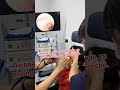 Huge Earwax Plug Extracted 🔥 | Extreme Ear Blockage Removal #Doctor #EarCare #Viral