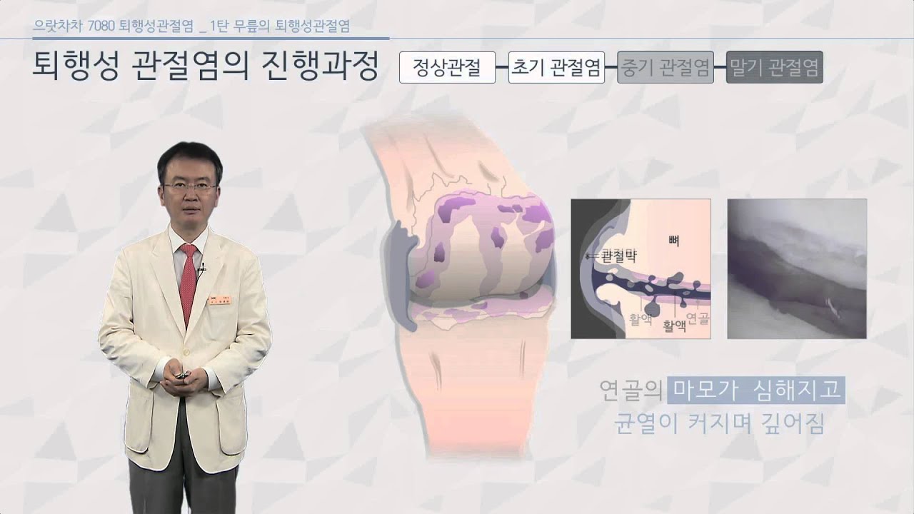 으랏차차_퇴행성관절염_1_퇴행성 관절염이란? - 정형외과 문영완 교수[의료진 ON Line 강의]