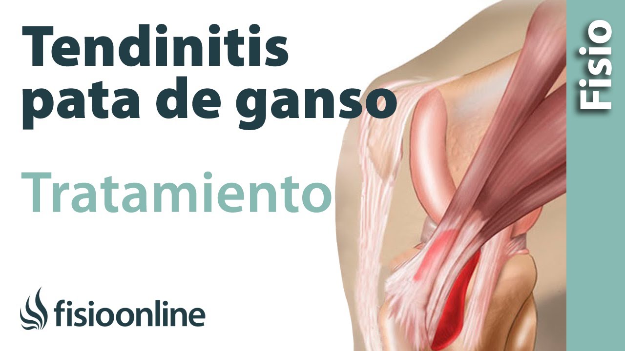 tendinitis pata de ganso tratamiento fisioterapia