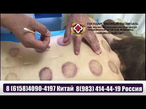 Процедура иглоукалывания в госпитале ТКМ в Китае Далянь