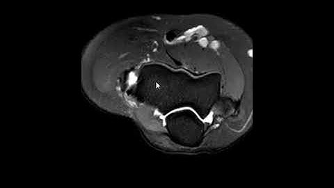 Tear of common extensor tendon origin