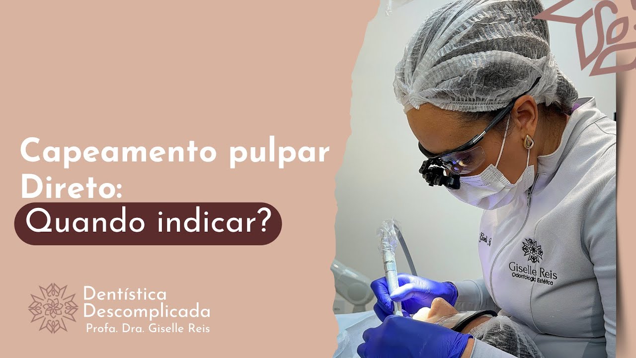 CAPEAMENTO PULPAR DIRETO: Quando Indicar? | Dentística Descomplicada ...