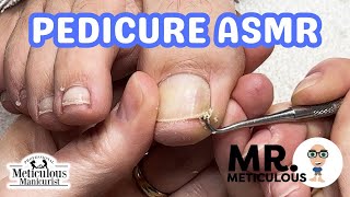 ASMR Pedicure Cleaning‍️ Epic Impacted Toenail Debris Removal on Mr. Meticulous