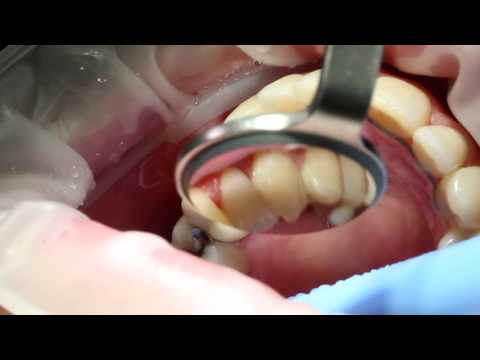 Fixing cavity with dental laser