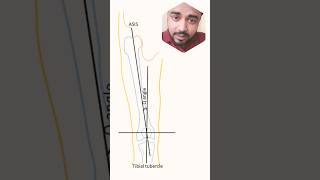whats a Q Angle? #physiotherapy #quadriceps #physicaltherapy #okphysio Q Angle Or Patellofemoral Angle