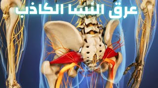 عرق النسا الكاذب| متلازمة العضلة الكمثرية|علاج عرق النسا الكاذب|عرق النسا|دكتور احمد حسن جمعه