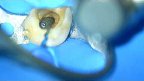 Reprocessing of a 34 with fiber post removal, Dott F. Bellucci