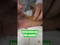 ABG sampling #abgs #medical #nursing #health #skincare