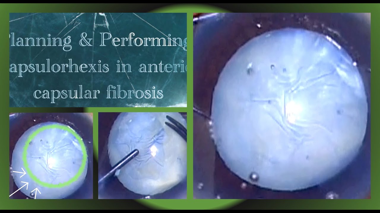 Capsular Fibrosis