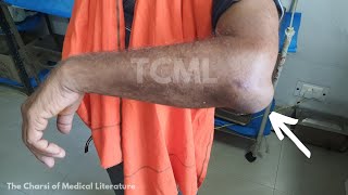 Olecranon Bursitis / Students Elbow | TCML