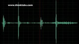 Normal Third Heart Sound (S3)