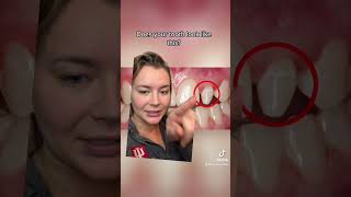 Peg laterals! #shorts #braces #orthodontist #peglateral