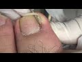 Sharp nail inside toe