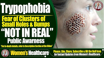Trypophobia | Fears of Clusters of Small Holes And Bumps | Women