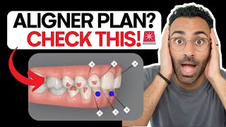 Make These Changes Before Approving The Aligner Treatment Plan