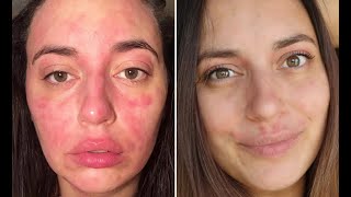 Tabletki Na Trądzik - Mega Skuteczne Sposoby Na Trądzik Moja Opinia