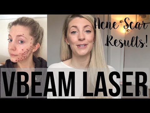 HOW TO GET RID OF ACNE SCARS: MY LASER RESULTS