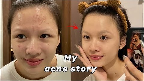 Hành trình trị mụn của mình 😭