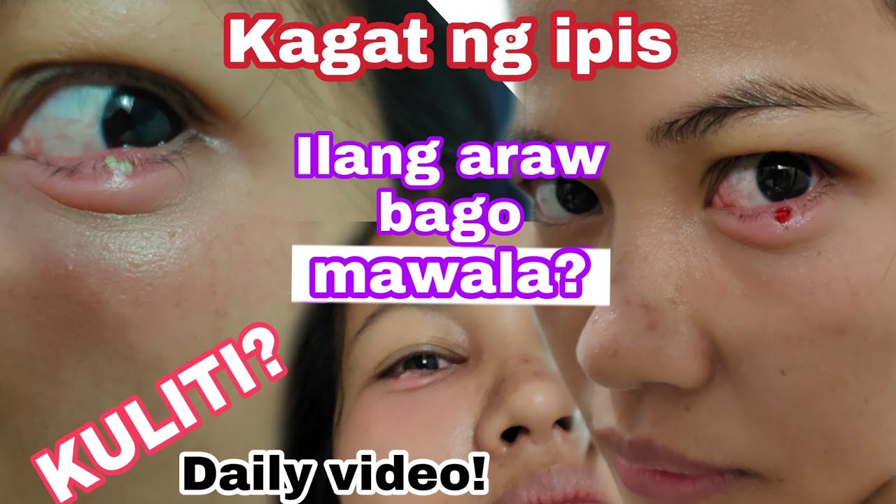 Kagat ng ipis sa mata daily update with videos | kuliti sa mata anong