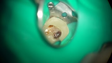 17985 broken file removal easy case with MT, TFRK S