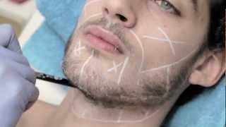 Epilation laser du visage chez l'homme - Centre Epilium à Paris - YouTube