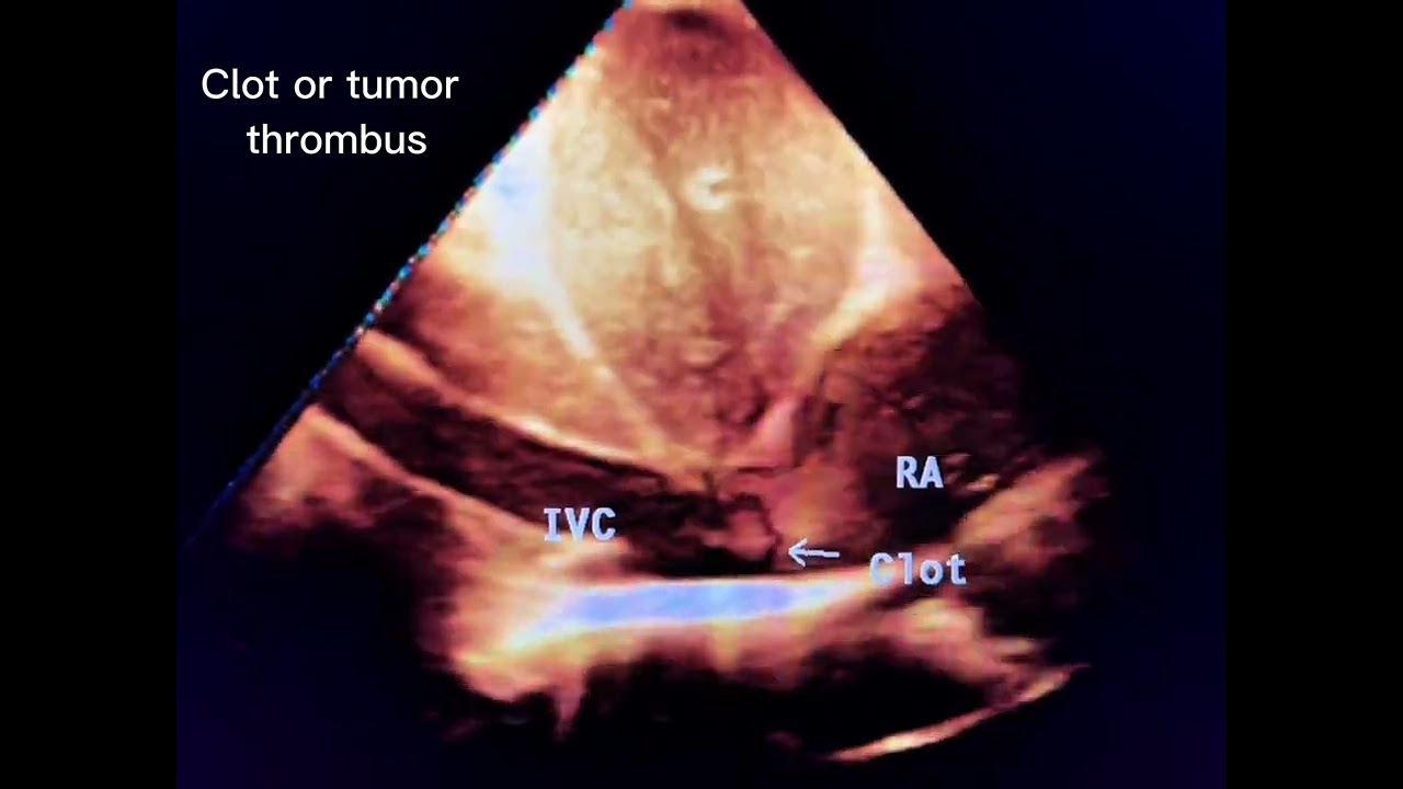 IVC Thrombus: A Rare Paraneoplastic Sign of Gastric Cancer