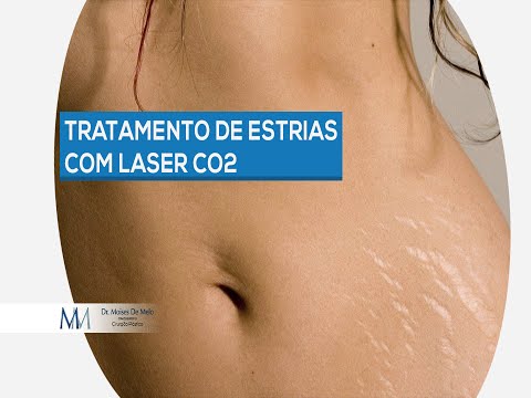 Dr. Moises De Melo | Tratamento de estrias com Laser CO2
