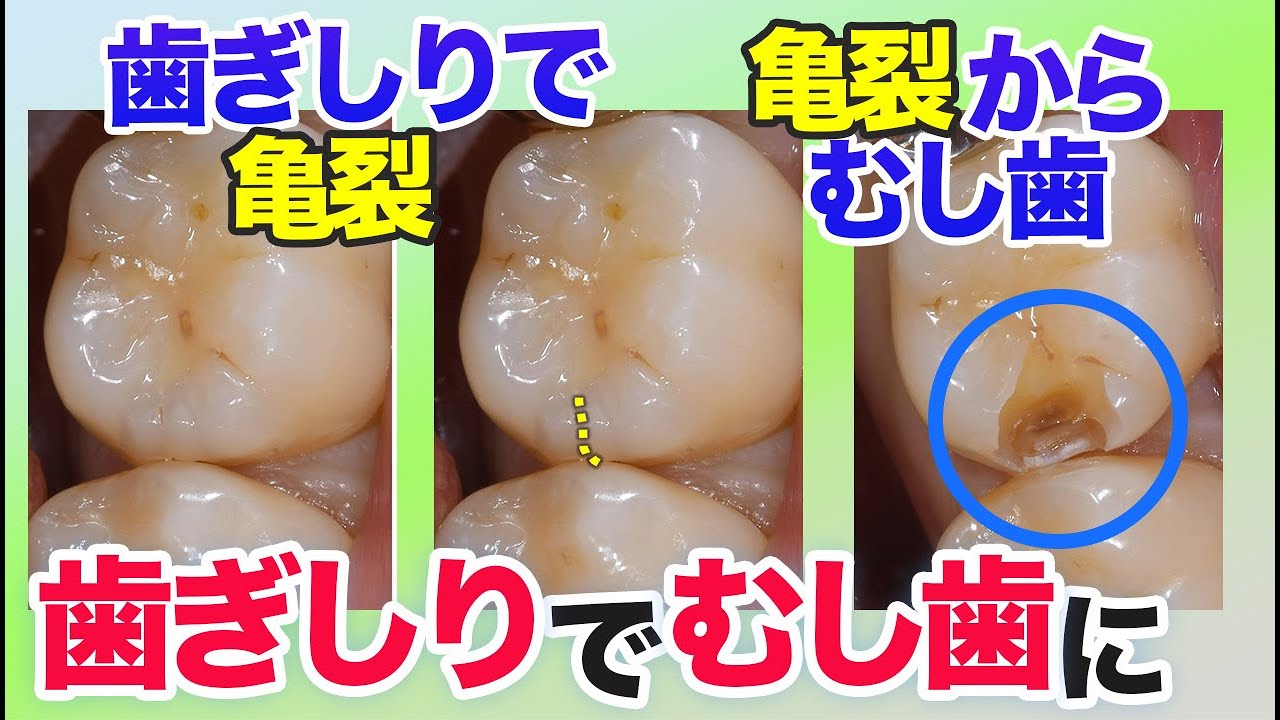 歯ぎしりでむし歯になる事例【歯科医師解説】