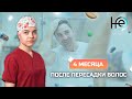 4 месяца после процедуры. Какие изменения происходят с волосами?