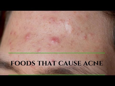 Foods that Cause acne/pimple| Avoid these foods for clear skin | guarantee % works