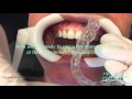 Starting Invisalign Treatment: Placing Attachments and Fitting Tray #1