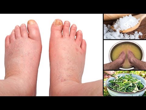 Video: Hausmittel Gegen Geschwollene Füße: 10 Behandlungen, Die Wirken