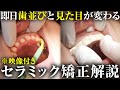1日で激変!セラミック矯正の治療を映像付きで解説します | 歯を白くする方法