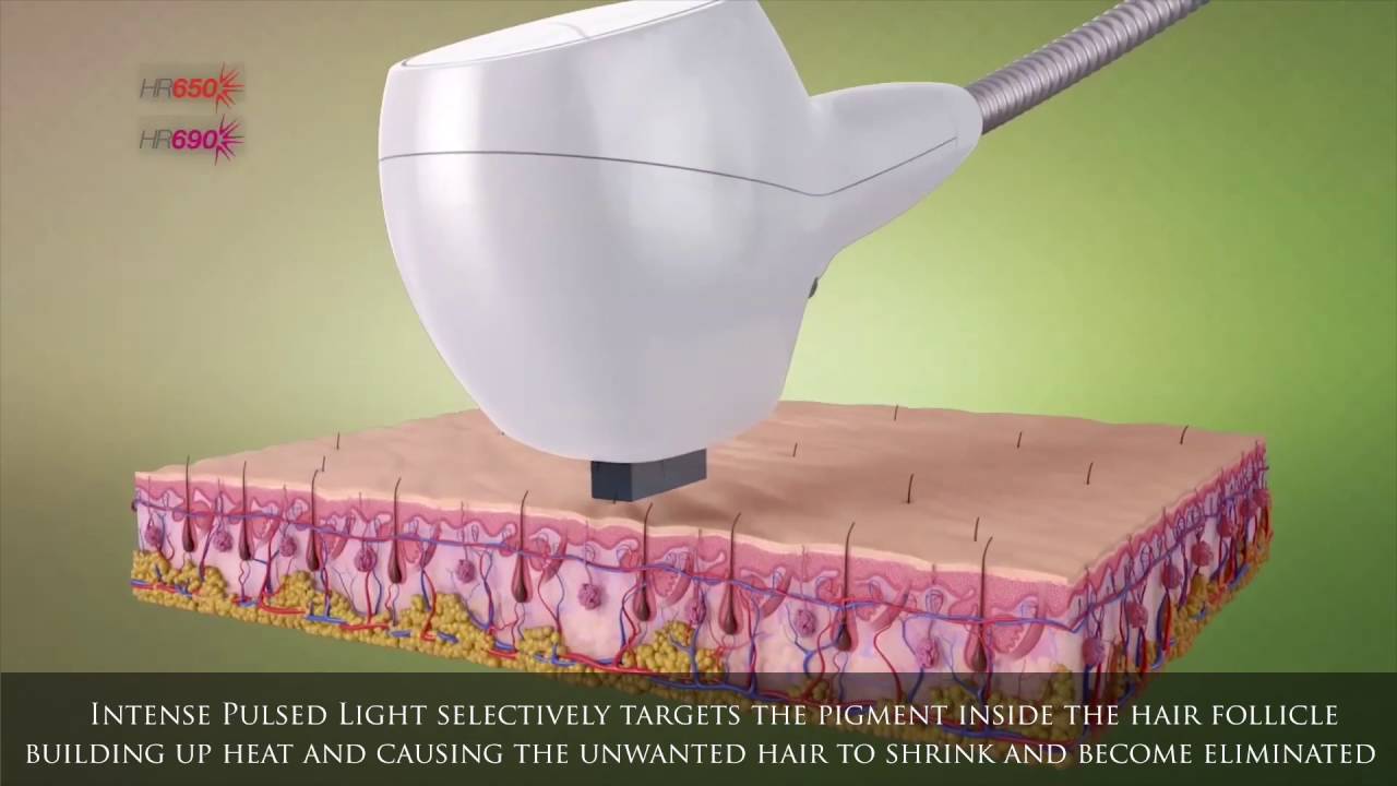 Venus Versa™ Depilación/Hair Removal Treatments - YouTube