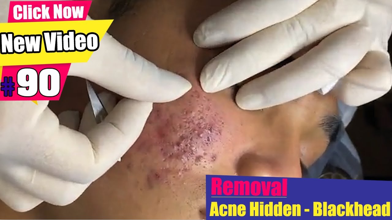 Remove Blackheads and Acne Hidden For Young Men - Acne Treatment(#90)