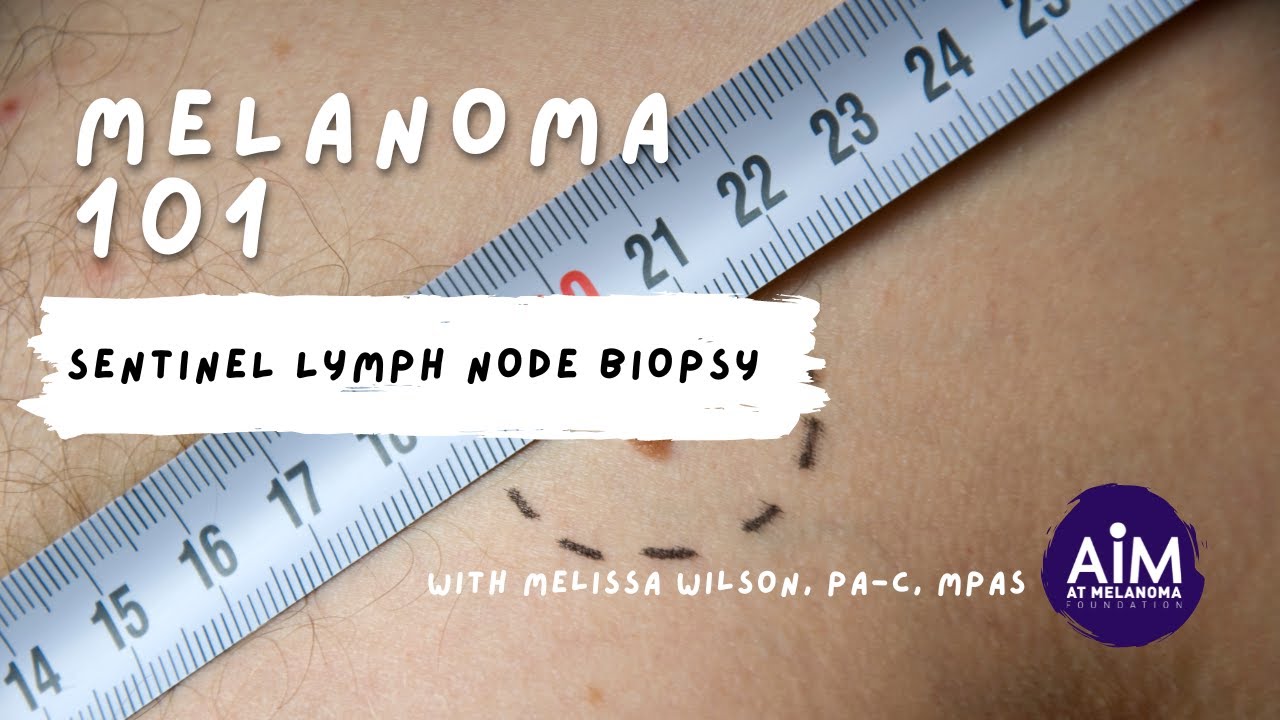 Sentinel Lymph Node Biopsy YouTube