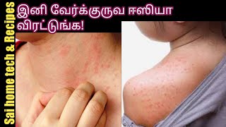 வேர்க்குருவை விரட்ட எளிய வழிகள்/Verkuru home remedies in Tamil