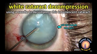 intumescent white cataract needle decompression
