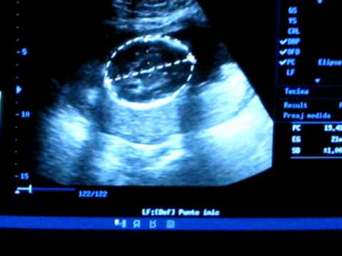 dolores a los 5 meses de embarazo