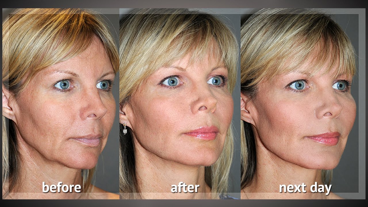 Y LIFT ® 2012 - Renée  Instant, Non Surgical Facelift 