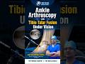 Ankle Arthroscopy with Tibio Talar Fusion Under Vision | Knee, Shoulder & Ligament #surgeon #indore