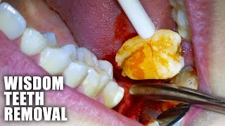 Full Wisdom Teeth Removal Procedure! Emergency Extraction of Impacted \& Partially Erupted Molar