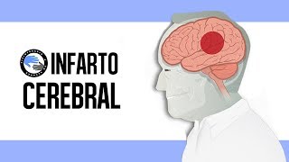 Stroke, cerebral infarction, or stroke: what is it? Identification and prevention