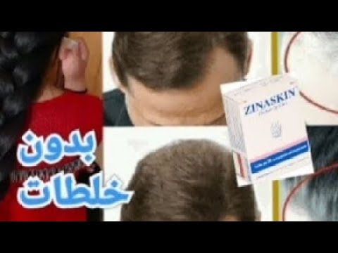 تجربتي الناجحة مع حبوب الزنك زيناسكين للشعر نتيجة فالشهر الاول شعر كثيف وقوي من الجذور