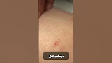 بق الفراش يغزو فرنسا 