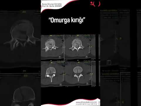 Omurga kırıklarında hangi tedaviler uygulanabilir? - Omurga Cerrahisi Uzmanı Prof. Dr. Burak Akesen