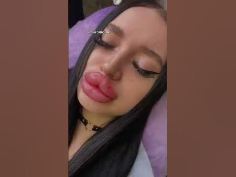 Ботокс губ и ресниц - YouTube