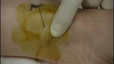 Saphenous Block (sample) - www.proceduresconsult.com